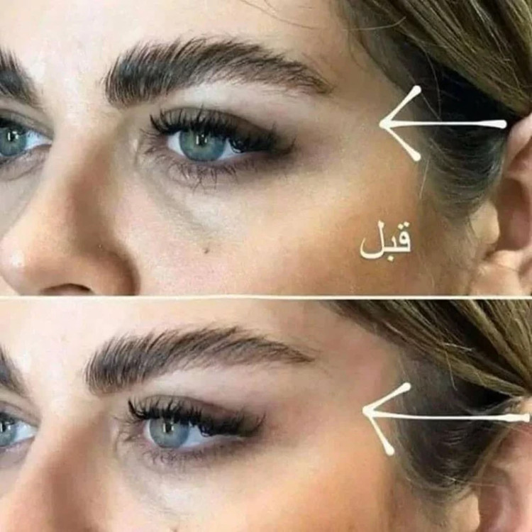 کش لیفت شقیقه و ابرو